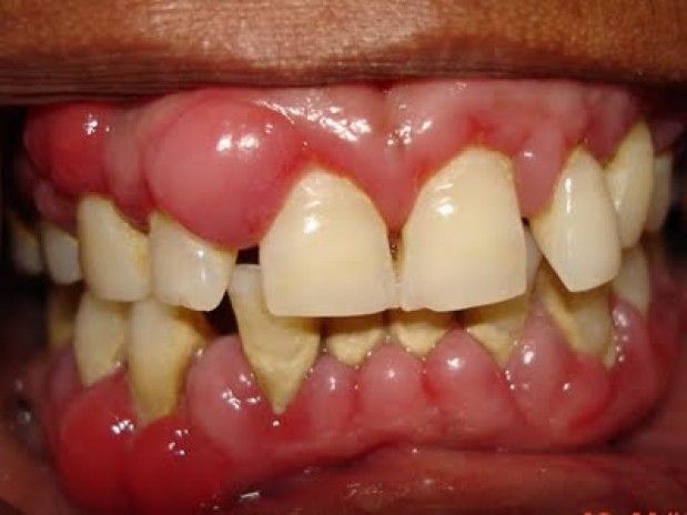 Swollen Or Puffy Gums